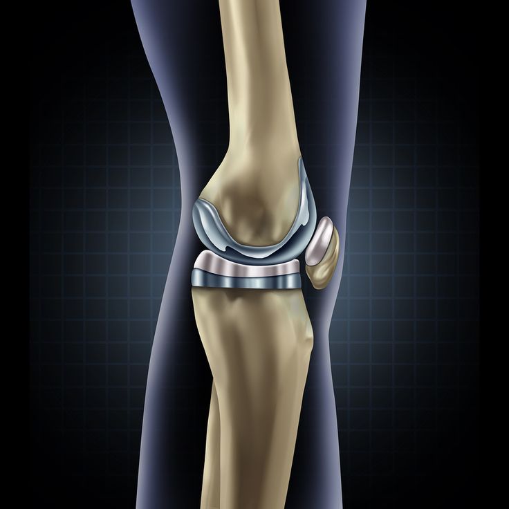 Knee Replacement