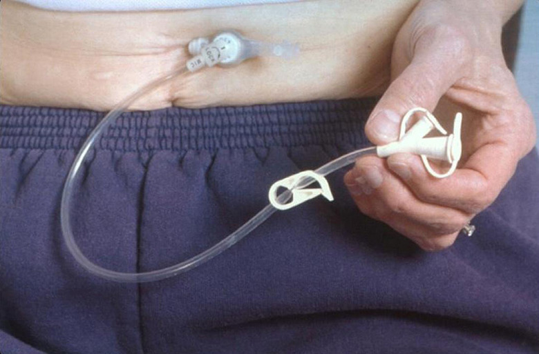 Percutan Endoscopic Gastrostomy