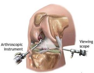 Arthroscopic Surgery