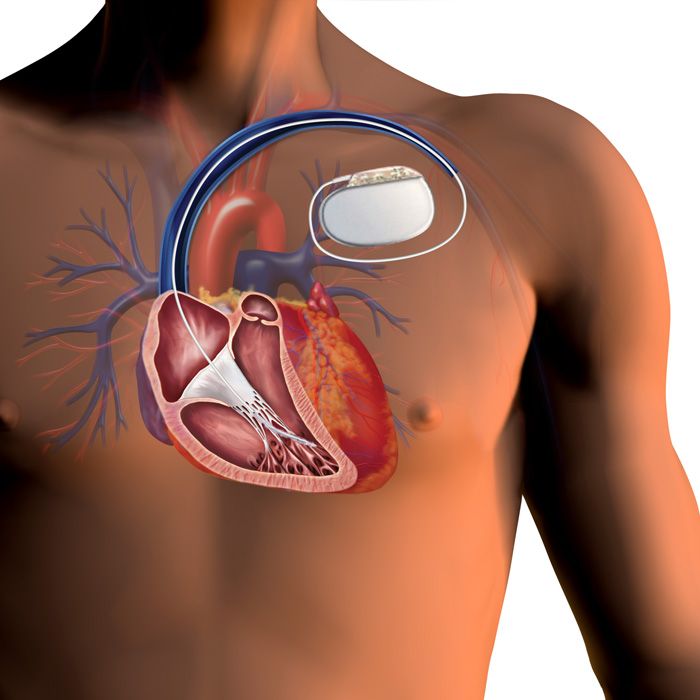 Pacemaker Battery Replacement