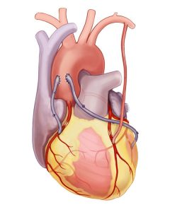 Coronary Bypass​