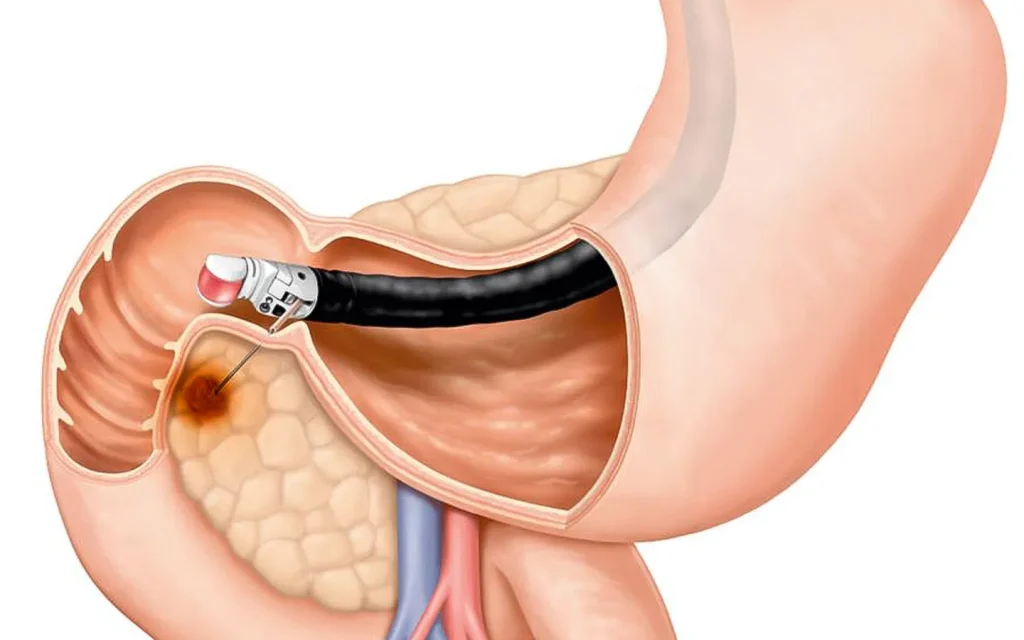 Endoscopic Ultrason