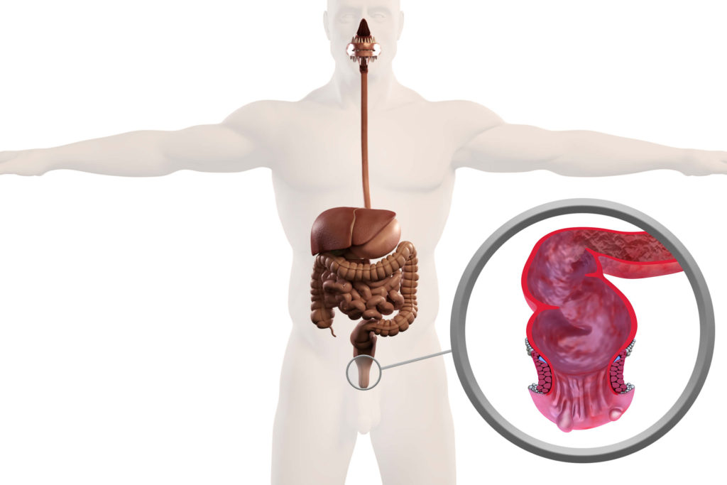 Hemorrhoidectomy