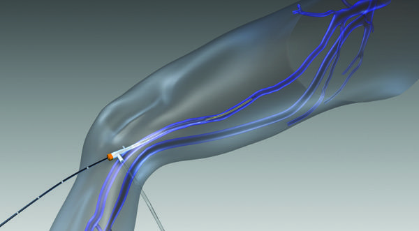 Endothermal Ablation