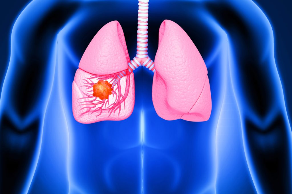 Lung Tumor Surgery