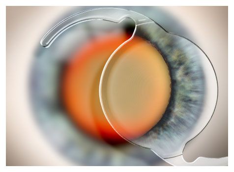 Cataract Surgery and Intraocular Lens Implants