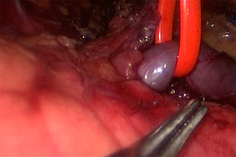 Laparoscopic Spleen Removal (Splenectomy)