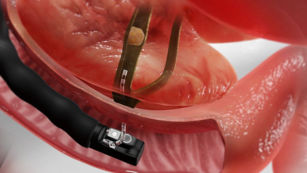 Ercp Endoscopic Retrograd Colangyo Pancreatography