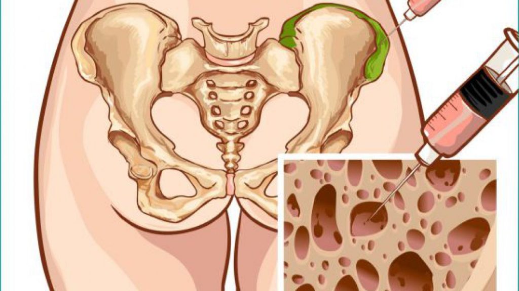 Adult Bone Marrow Transplantation