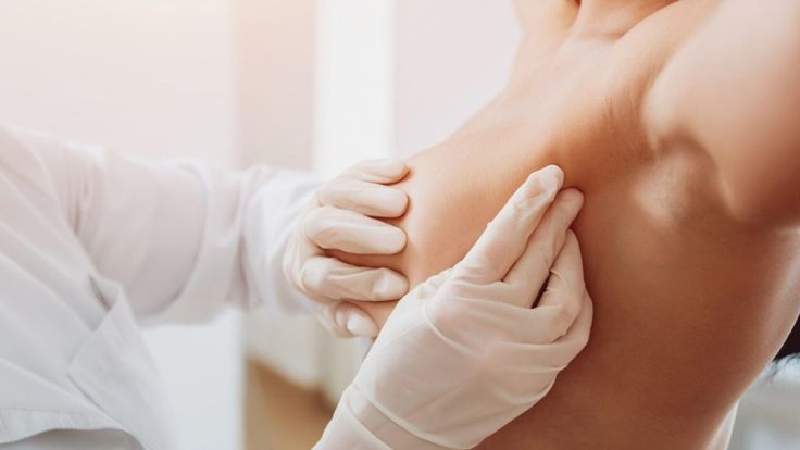 Breast Surgery (Breast Cancer)