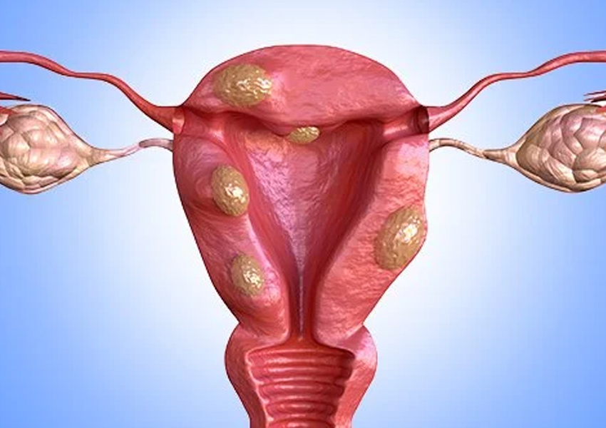 Myomectomy (Removal Of Uterine Fibroids)