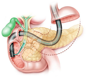 Ercp Endoscopic Retrograd Colangyo Pancreatography