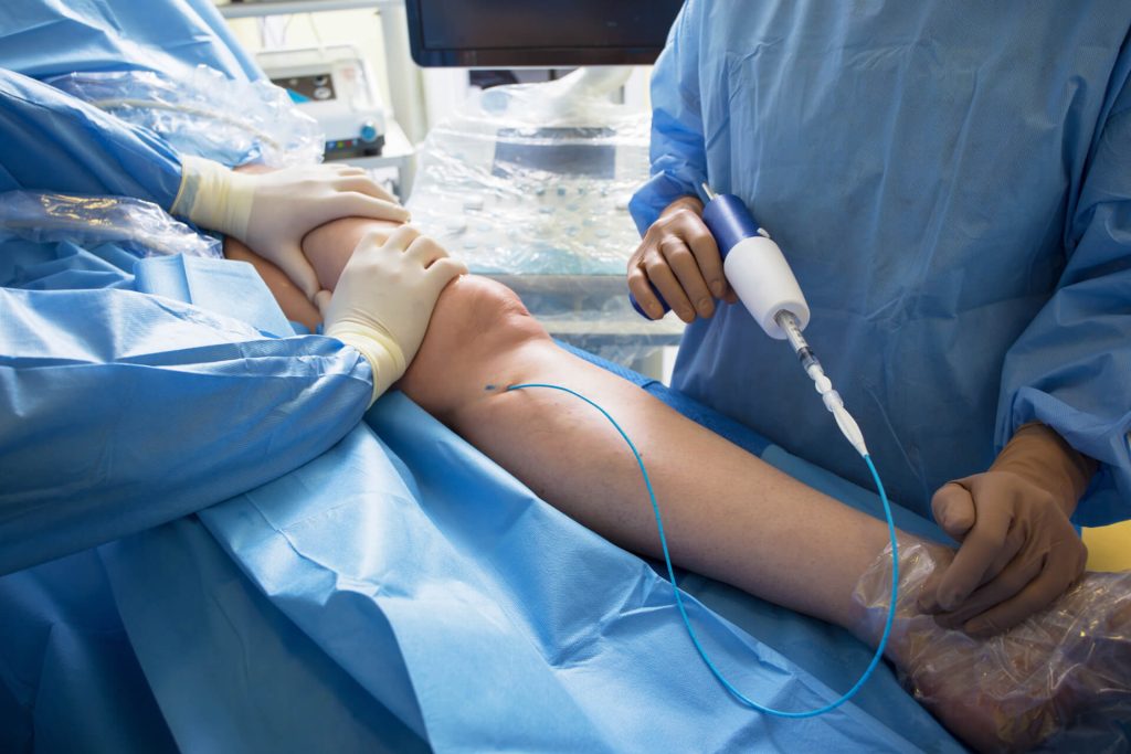 Endoscopic Vein Surgery