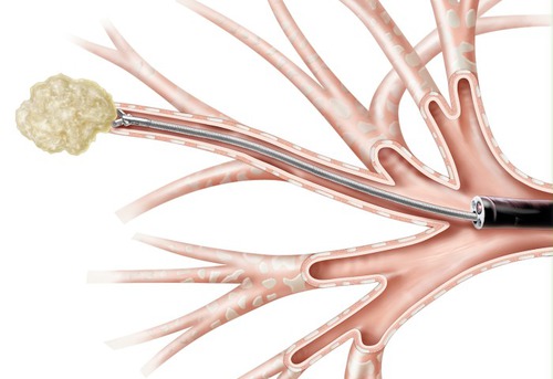 Bronchoscopy