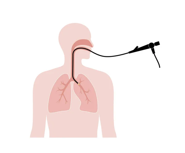 Bronchoscopy