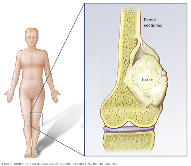 Orthopedic Tumor Surgery