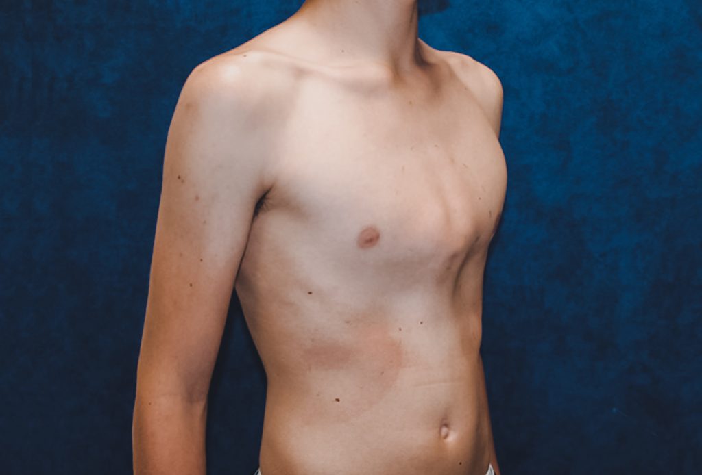 Килевидная Деформация Грудной Клетки (Pectus Carinatum)