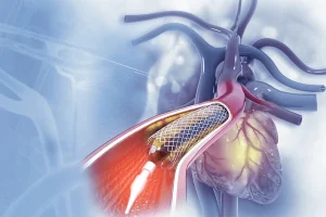 Radial Angiography