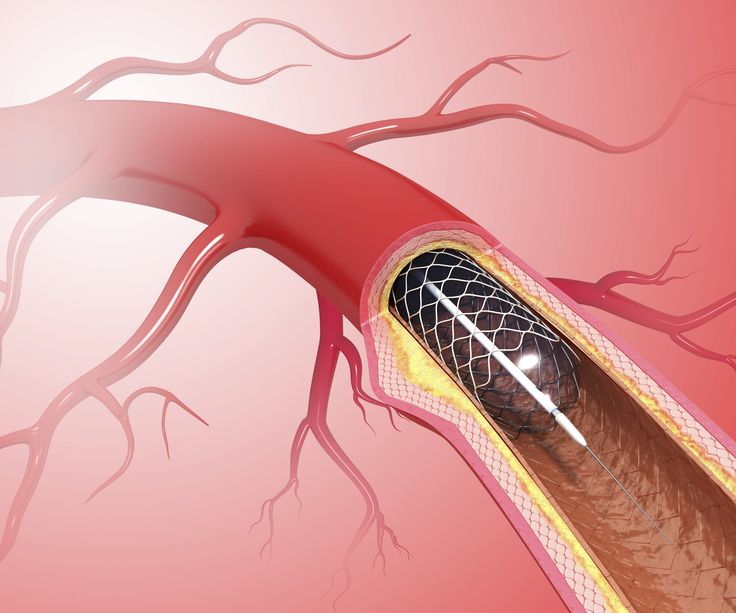 Stent Placement