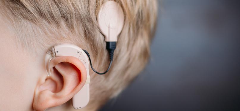 Cochlear Implant Placement