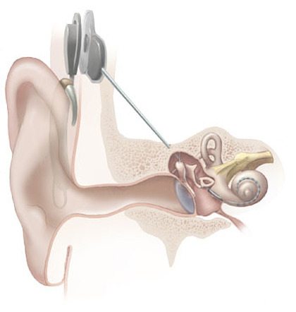 Cochlear Implant Placement