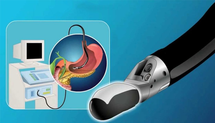 Endoscopic Ultrason (Eus)