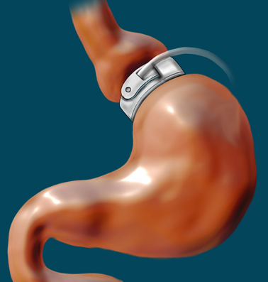 Gastric Band