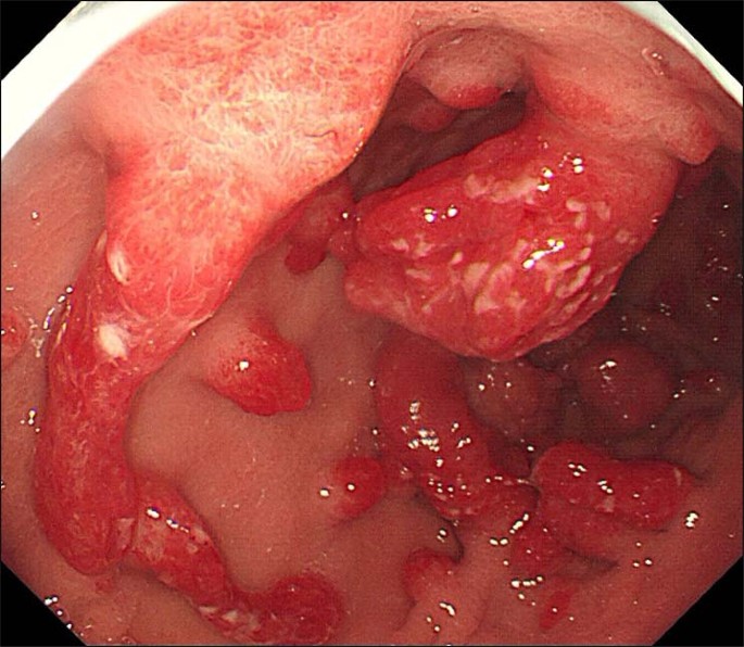 Gastric Polyps Removal