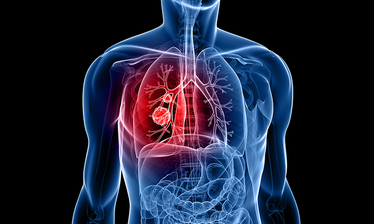 Lung Tumor Surgery