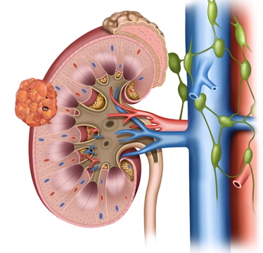 Nephrectomy