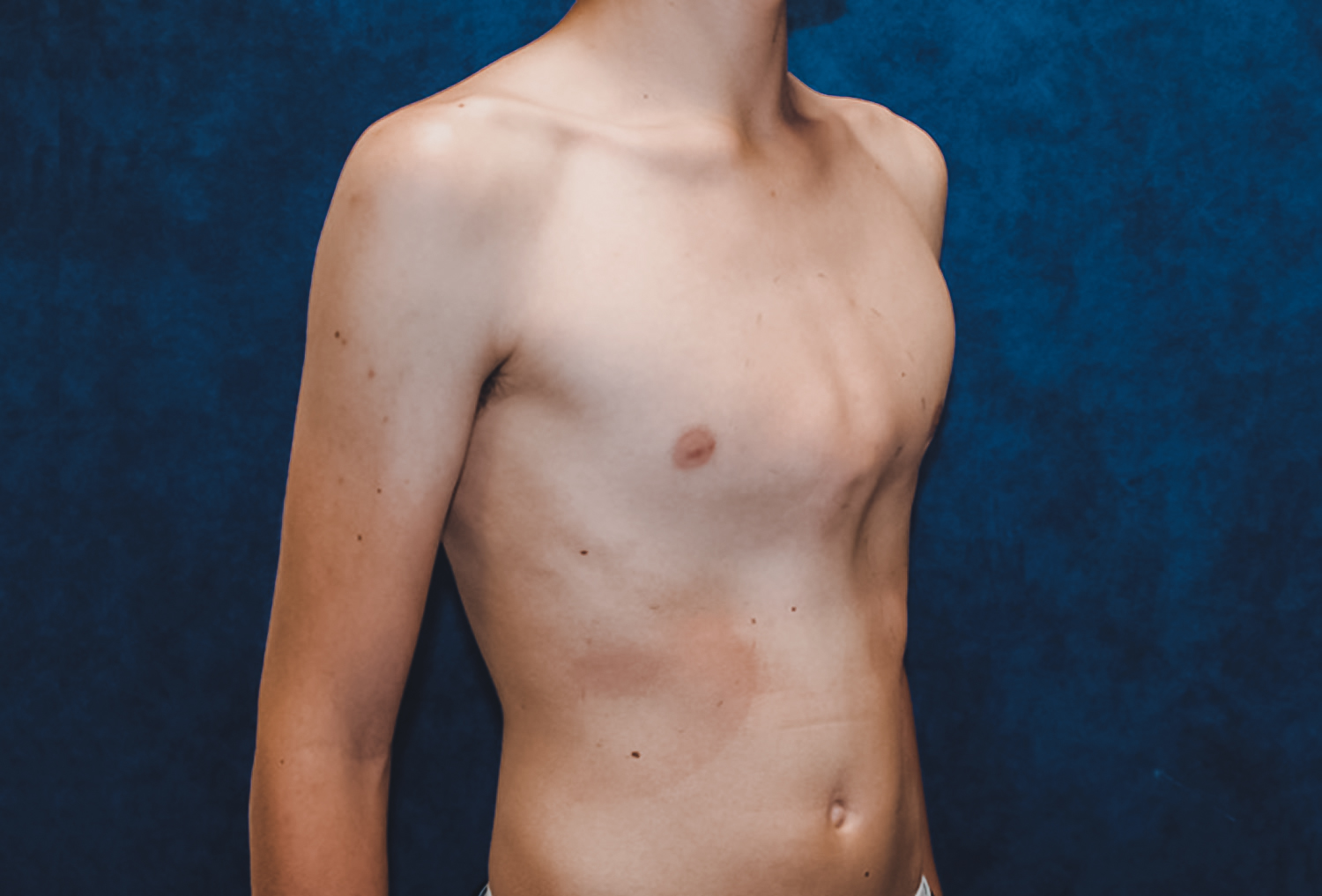 Pectus Carinatum