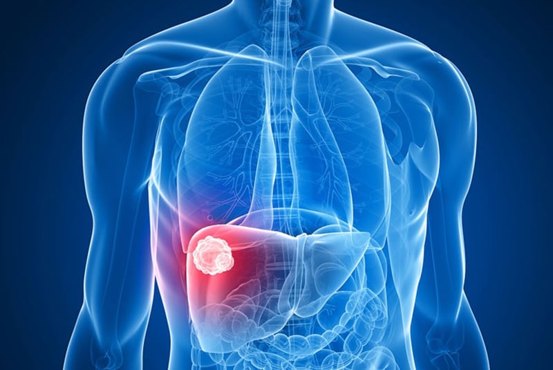 liver cancer