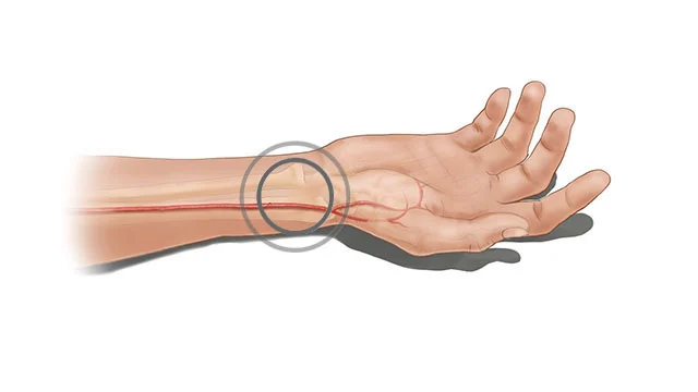 Radial Angiography