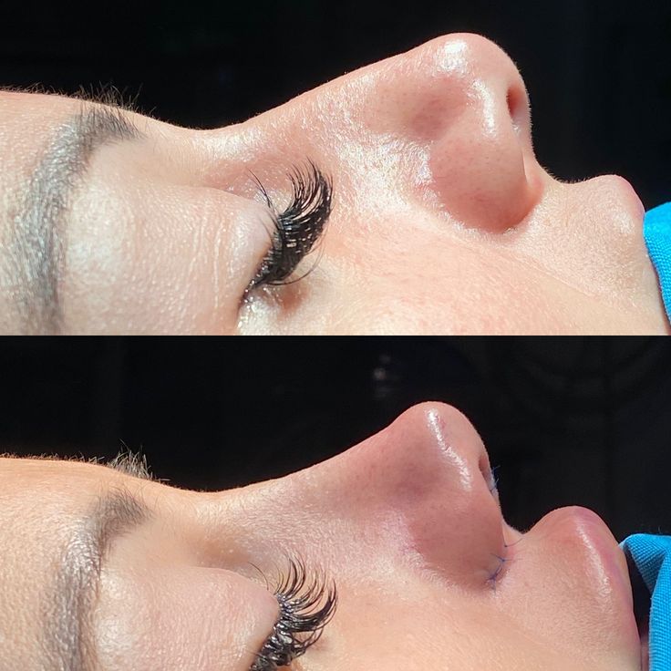 Rhinoplasty (Letdown & Closed)