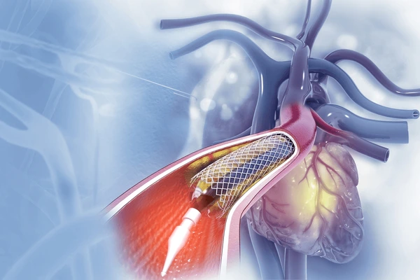 Radial Angiography