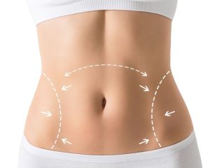 Tummy Tuck