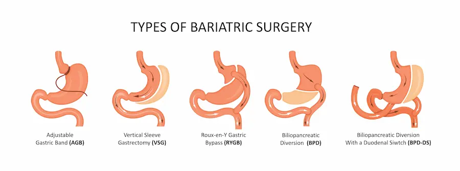 Types of Bariatric Surgery