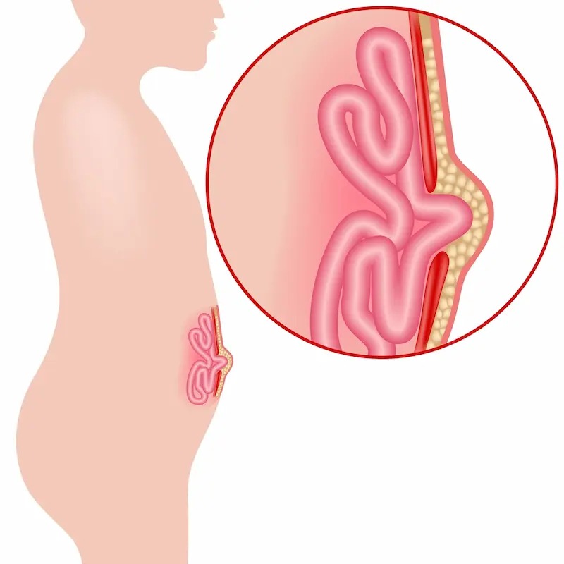 An umbilical hernia manifests as a soft bulge or swelling in or very close to your navel (umbilicus).
