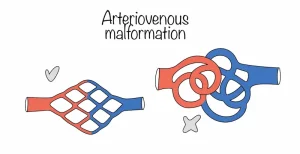 Arm AVM Treatment in Turkey