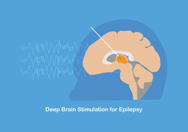 DBS at anterior thalamic nucleus for treatment of drug resistant epilepsy