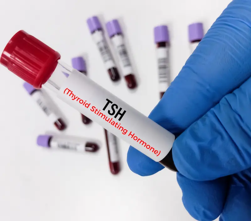 Thyroid Stimulating Hormone