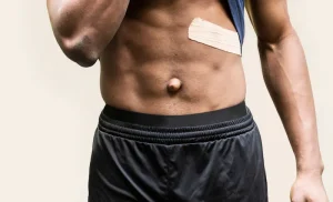 Umbilical Hernia Repair in Turkey