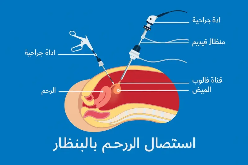 استئصال الرحم بالمنظار