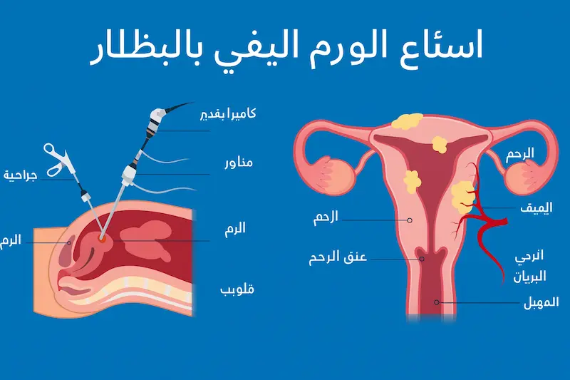 استئصال الورم العضلي بالمنظار