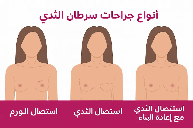 أنواع جراحات سرطان الثدي