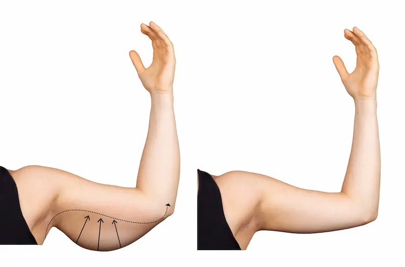 arm lift turkey before after