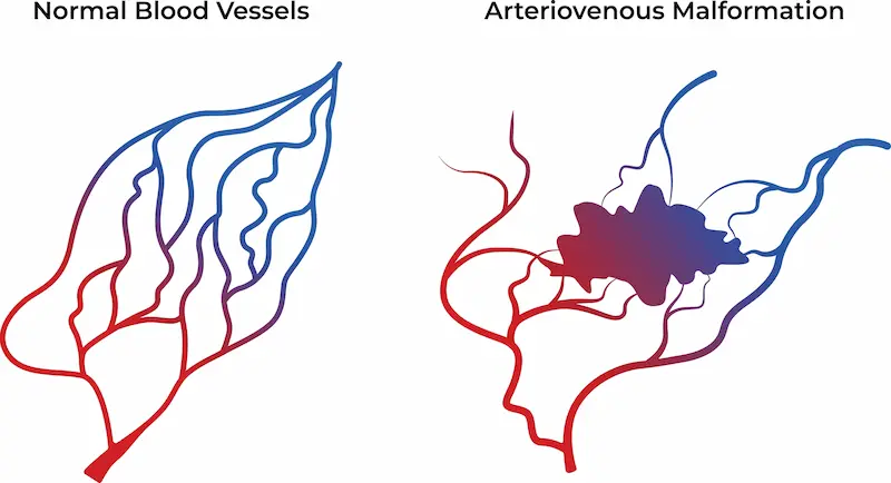 Arteriovenous Malformation (AVM)