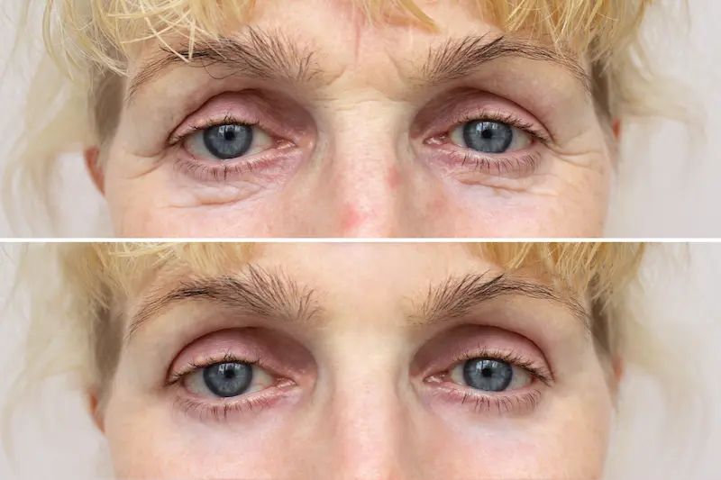 Blepharoplasty Before and After