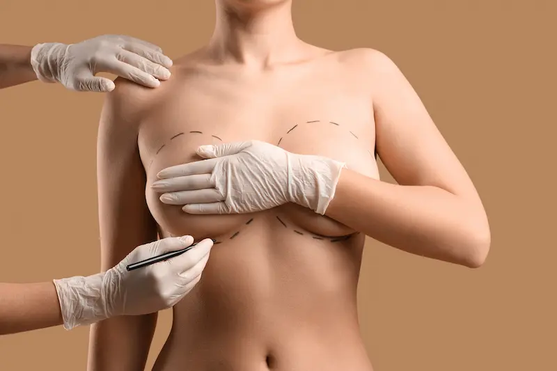 Breast Augmentation in Turkey