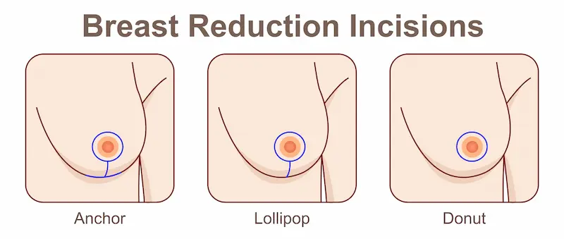 breast reduction consultation